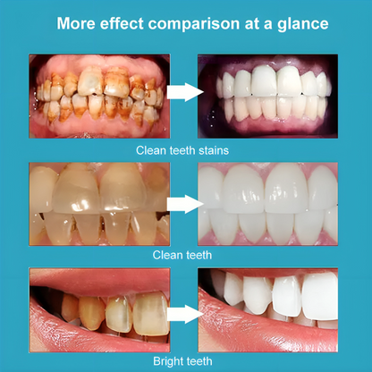 BrightSmile™ Zahnaufhellungs-Stift | 1+1 GRATIS